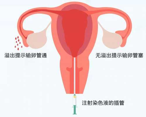 国内供卵需要准备什么,剖腹产适合做试管婴儿吗